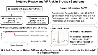 The Utility of Notched P-Wave on the Occurrence of Ventricular Fibrillation in Patients With Brugada Syndrome.