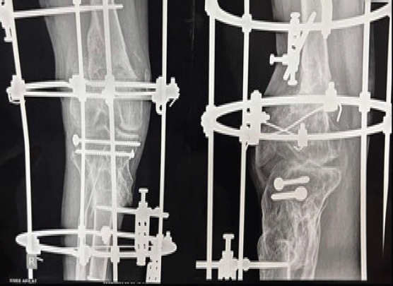 Knee Arthodesis , as a salvage procedure for Non-union of floating knee after ilizarov fixation-A case report.