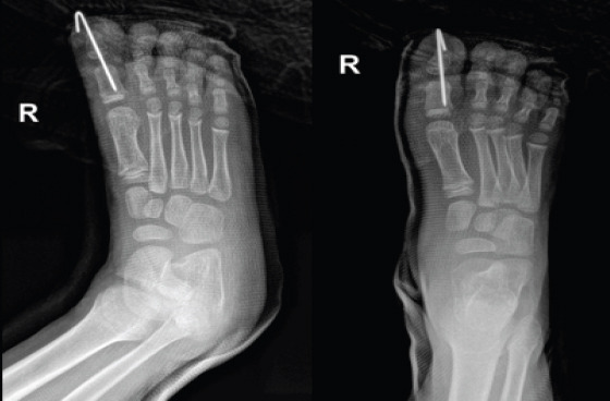Open Dislocation of Hallux Interphalangeal Joint in a Child: A Rare Case Report.