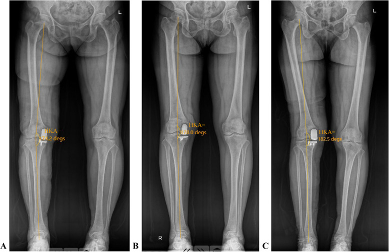 Predicting postoperative coronal alignment in medial unicompartmental knee arthroplasty using the arithmetic hip-knee-ankle angle.
