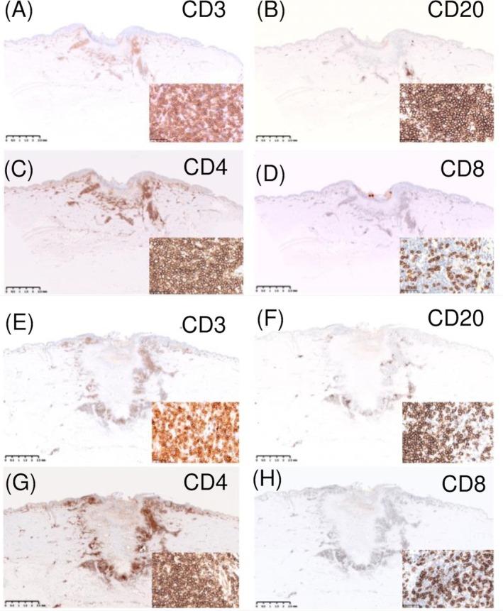 Cutaneous Pseudolymphomas With Identical Clinicopathological Features Induced by Tick Bites at Two Separate Sites.