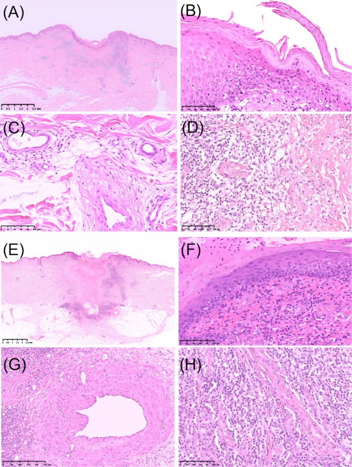 Cutaneous Pseudolymphomas With Identical Clinicopathological Features Induced by Tick Bites at Two Separate Sites.