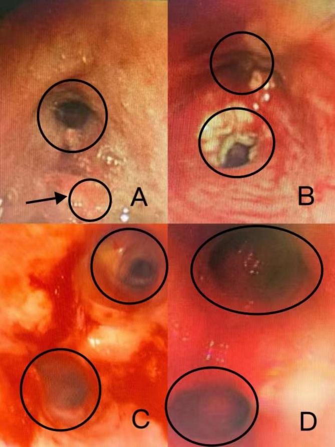 A Case of Advanced Lung Adenocarcinoma Successfully Treated by Intratumoral Injection of Tirelizumab Under Tracheoscopy.