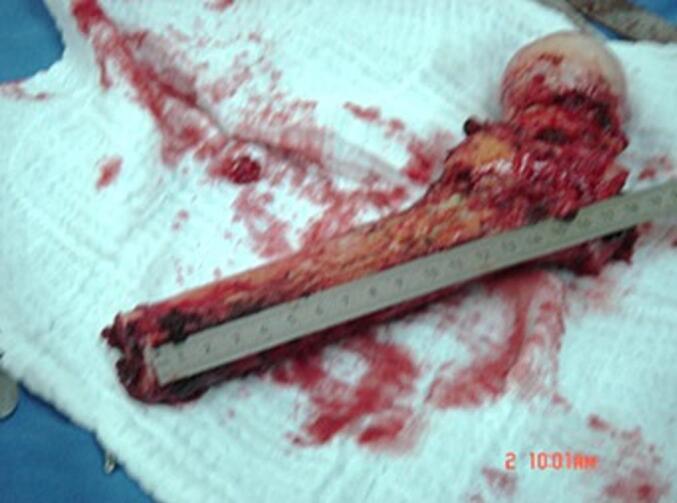 Mesh application enhances osteoinduction following proximal femur chondrosarcoma resection and Total hip arthroplasty: A case report and novel technique.