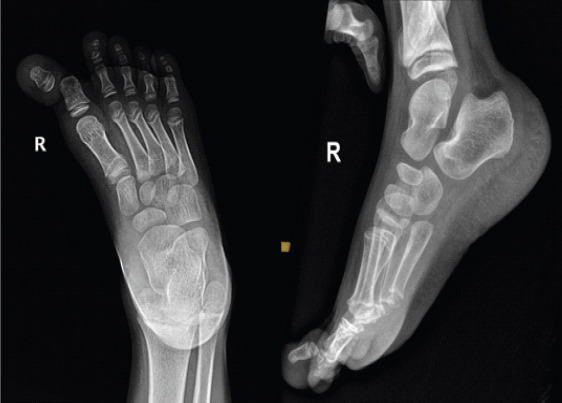 Open Dislocation of Hallux Interphalangeal Joint in a Child: A Rare Case Report.