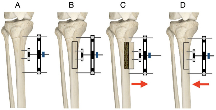 A Systematic Review on Tibial Cortex Transverse Transport in the Treatment of Ischemic Ulcers of the Lower Limb.