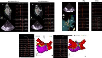 Unipolar Signal Augmentation as a Novel Marker of Tissue Contact in Pulsed Field Ablation.