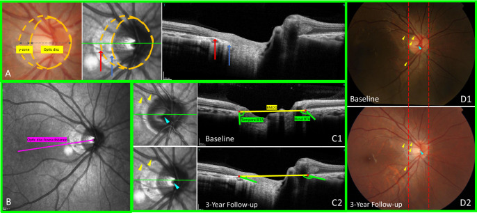 Association of Optic Nerve Head Metrics and Parapapillary Gamma Zone With Myopia Onset and Progression in Children: The Hong Kong Children Eye Study.