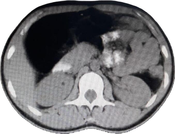 Incidental discovery of a large mesenteric lipoma in a child following minor trauma: A case report.