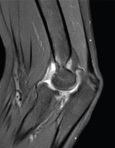 Elbow Dislocation Associated with Severely Displaced Radial Neck Fracture and Ulnar Diaphyseal Fracture in an 11-Year-Old Girl - A Very Rare Case Report.
