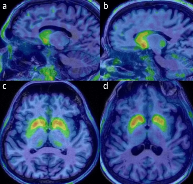 Multimodal imaging analysis of autosomal recessive Parkinson’s disease