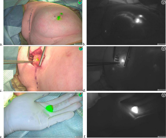 The use of indocyanine green and technetium-99 for dual-tracer sentinel lymph node biopsy in breast cancer.