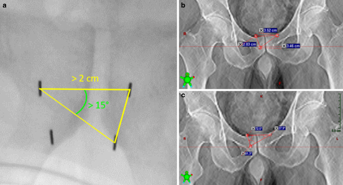 Implant geometry and detection rates of prostate fiducial markers after transrectal ultrasound-guided perineal implantation for image-guided 6D-tracking in robotic stereotactic body radiotherapy.