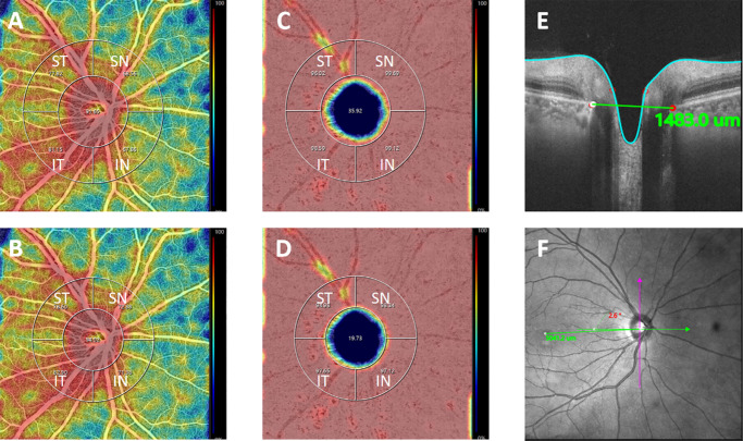 Swept-Source OCT Angiography-Derived Regional Normative Data of Peripapillary Vessel Density in Healthy Populations.