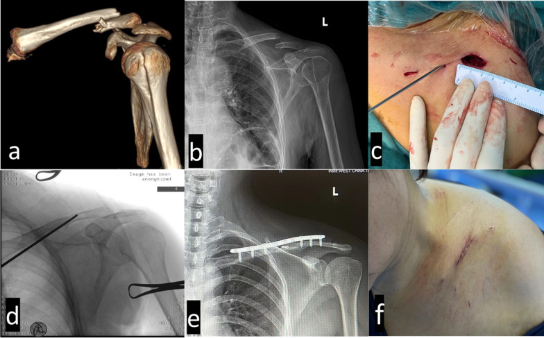 Minimally invasive plate osteosynthesis (MIPO) with mini-open technique versus open reduction and internal fixation (ORIF) in the treatment of displaced midclavicular fracture: a retrospective study.