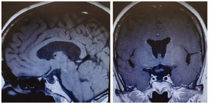 Sheehan's syndrome complicated with Graves' disease in a woman with a 20-year history of hypothyroidism.