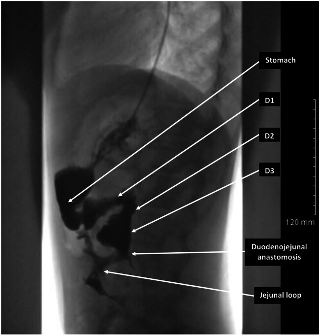 Robotic Duodenojejunostomy for a Rare Case of Acute Idiopathic Superior Mesenteric Artery Syndrome in a Teenage Girl.