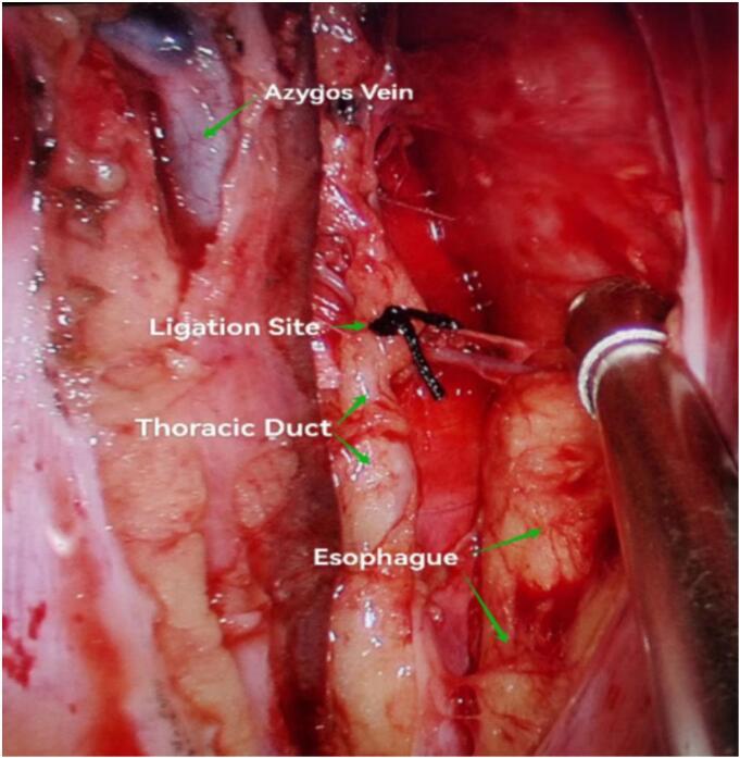 A rare case report of chylopericardium after esophageal cancer surgery: Diagnostic challenges and successful surgical management.