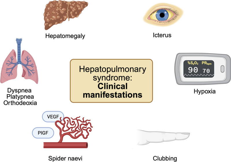 Hepatopulmonary syndrome: pathophysiological mechanisms and clinical implications.