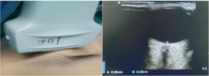 Effect of individualized PEEP on lung ultrasound score and optic nerve sheath diameter in elderly patients undergoing laparoscopic rectal cancer surgery: A randomized controlled trial.
