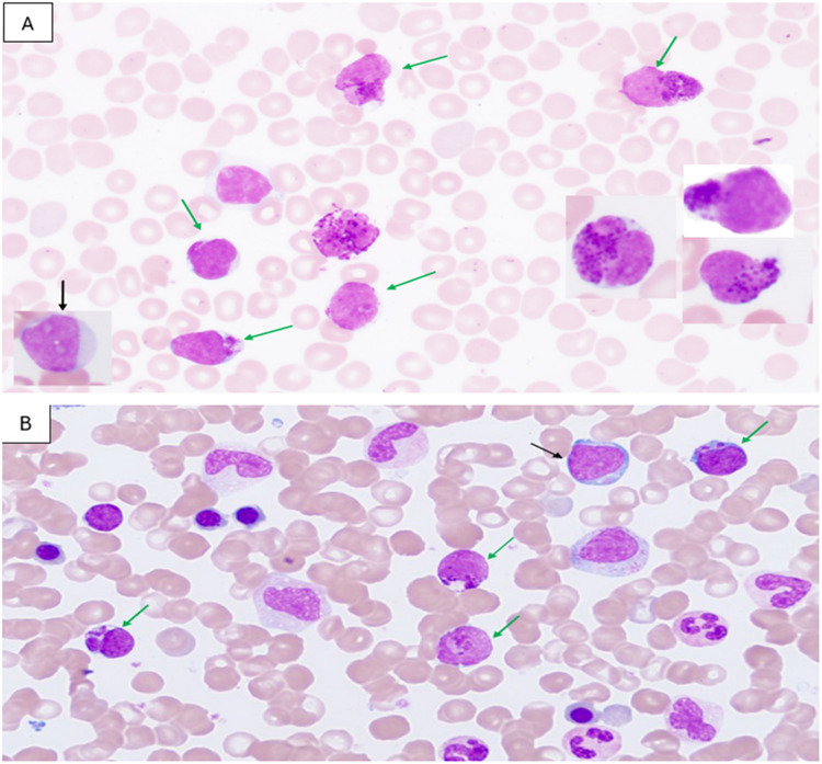Myelomastocytic transformation in chronic myeloid leukemia blast phase: A case report.