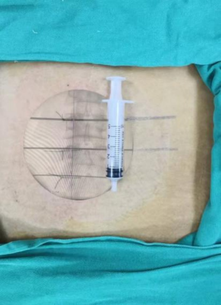 Comparison of Biportal Endoscopic Technique and Conventional Unilateral Laminectomy for Bilateral Decompression (ULBD) for Multi-Level Degenerative Lumbar Spinal Stenosis in Elderly People.