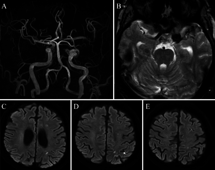 Proximal occlusion for infectious carotid-cavernous fistula caused by invasive fungal sinusitis: illustrative case.