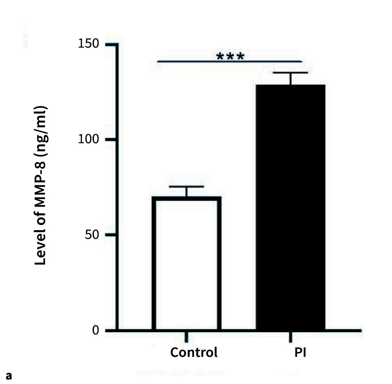Association of MMP-8 rs11225395 Polymorphism with the Susceptibility of Peri-Implantitis.