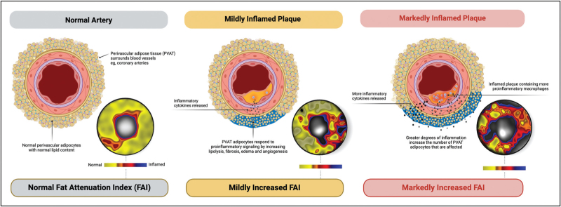 Orticumab: the potential to harness oxidized LDL to reduce coronary inflammation with plaque-targeted therapy.