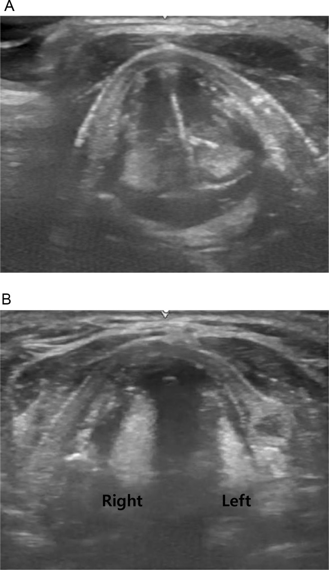 A Pilot Study of a Modified Swallowing Screening Tool for Critically Ill Patients in the Intensive Care Unit.