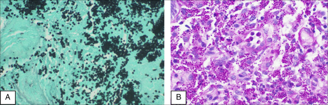 An Unexpected Culprit: Fatal Gastrointestinal Hemorrhage due to Duodenal Histoplasmosis in a Patient With End-Stage Renal Disease.