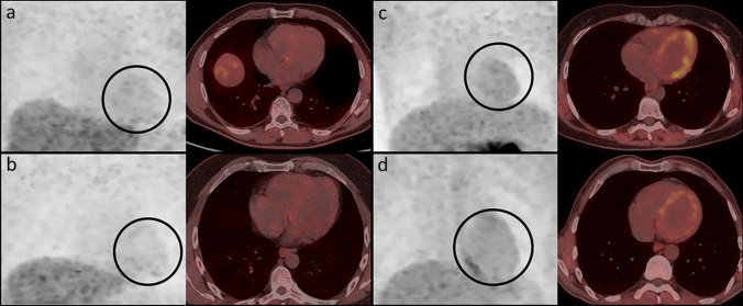 Multimodal imaging analysis of autosomal recessive Parkinson’s disease