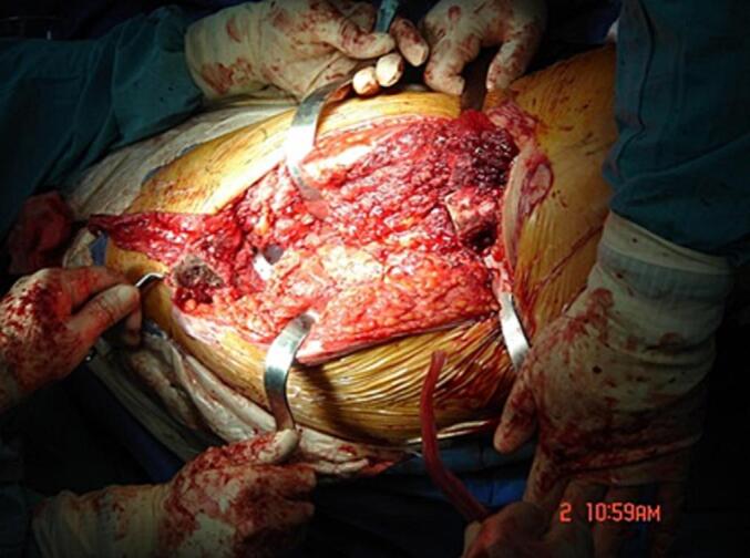 Mesh application enhances osteoinduction following proximal femur chondrosarcoma resection and Total hip arthroplasty: A case report and novel technique.