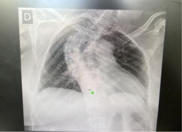 Thoracic Duct Injury in a Patient Undergoing Axillary Lymphadenectomy: A Case Report.