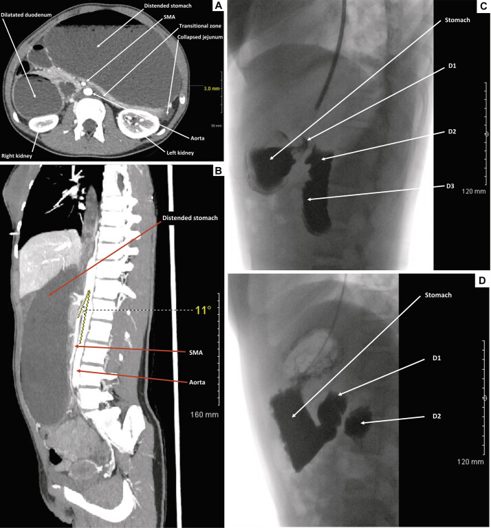 Robotic Duodenojejunostomy for a Rare Case of Acute Idiopathic Superior Mesenteric Artery Syndrome in a Teenage Girl.