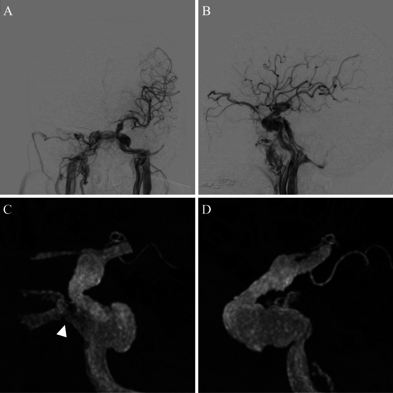 Proximal occlusion for infectious carotid-cavernous fistula caused by invasive fungal sinusitis: illustrative case.