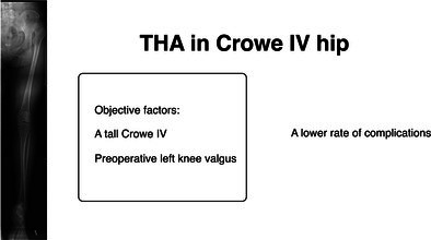 Factors Associated With Complications in 176 Crowe IV Hips Treated With Total Hip Arthroplasty.
