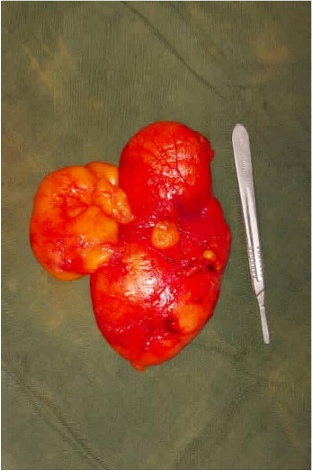 Incidental discovery of a large mesenteric lipoma in a child following minor trauma: A case report.
