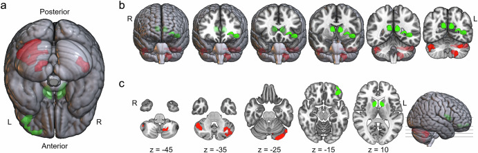 Impact of impulsivity on the relationship of the brain structures with school performance.