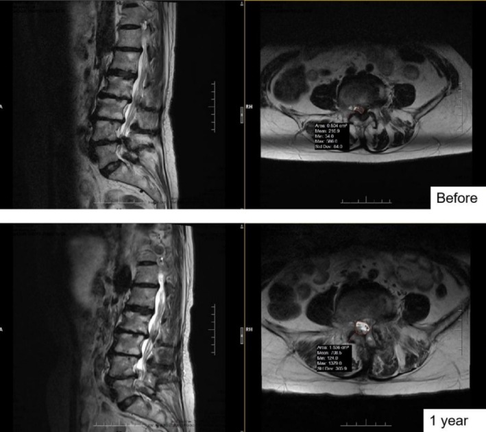 Comparison of Biportal Endoscopic Technique and Conventional Unilateral Laminectomy for Bilateral Decompression (ULBD) for Multi-Level Degenerative Lumbar Spinal Stenosis in Elderly People.