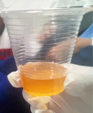 Thoracic Duct Injury in a Patient Undergoing Axillary Lymphadenectomy: A Case Report.