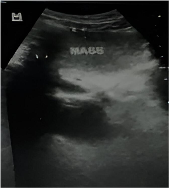 Incidental discovery of a large mesenteric lipoma in a child following minor trauma: A case report.