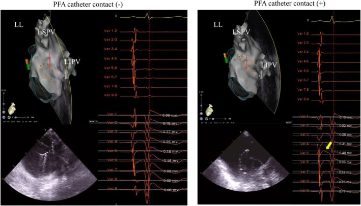 Unipolar Signal Augmentation as a Novel Marker of Tissue Contact in Pulsed Field Ablation.