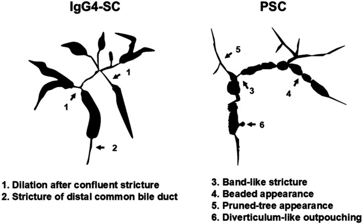 Endoscopic diagnosis of immunoglobulin G4-related sclerosing cholangitis.