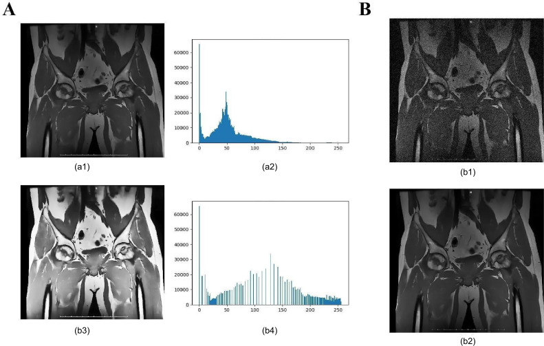 Predictive Modeling of Osteonecrosis of the Femoral Head Progression Using MobileNetV3_Large and Long Short-Term Memory Network: Novel Approach.