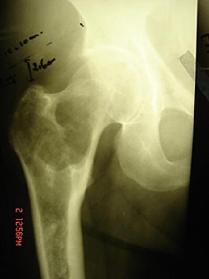 Mesh application enhances osteoinduction following proximal femur chondrosarcoma resection and Total hip arthroplasty: A case report and novel technique.