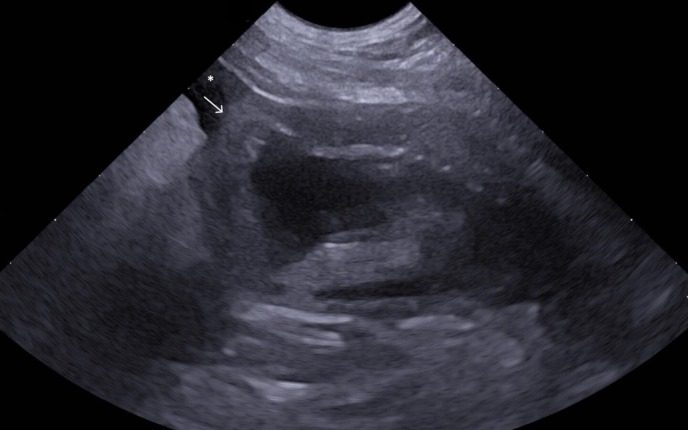 Spontaneous urinary bladder rupture in a dog with lymphoplasmacytic cystitis.