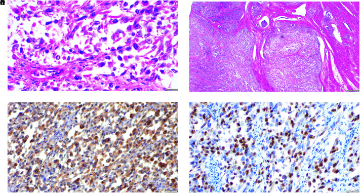 A Rare Case of Uterine Embryonal Rhabdomyosarcoma.