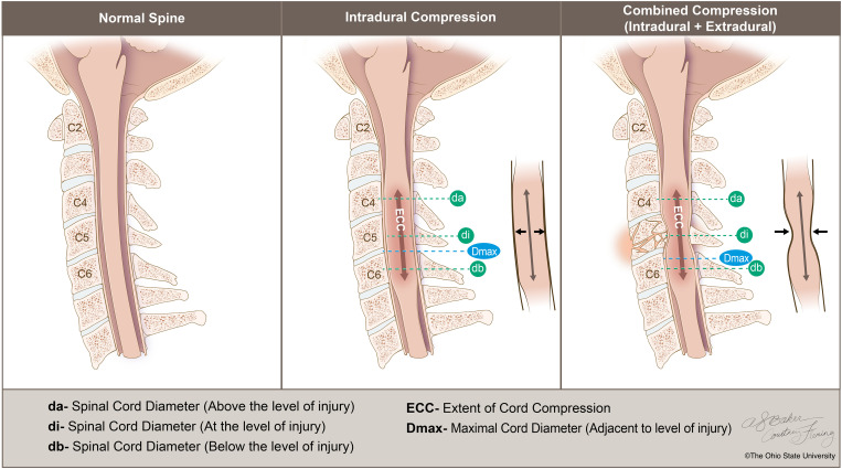 Spinal cord swelling and intradural compression predict neurological recovery after acute cervical traumatic spinal cord injury.