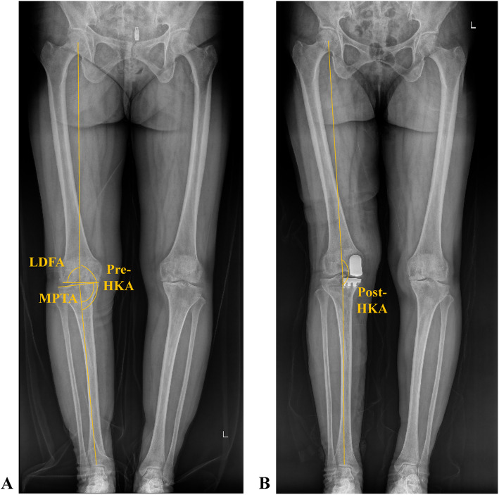 Predicting postoperative coronal alignment in medial unicompartmental knee arthroplasty using the arithmetic hip-knee-ankle angle.